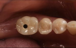 根の虫歯で抜歯になった下顎の奥歯をインプラントで再建した症例2